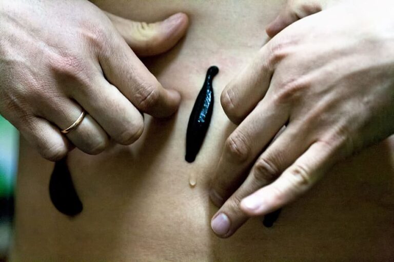 leeches-patient-healing-hirudotherapy